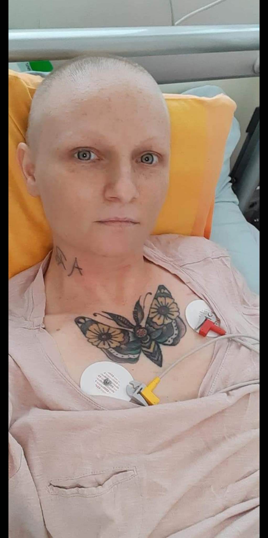 Kobieta bez włosów leży na łóżku w szpitalu